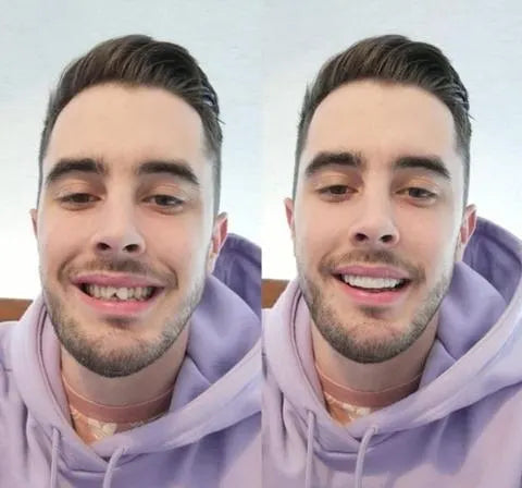 On Smile Veneers for Upper and Lower Jaw