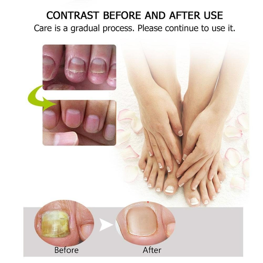 Buy One, Get One Free | Nail Repair Solution | Quick and Effective Results!