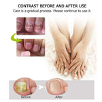 Buy One, Get One Free | Nail Repair Solution | Quick and Effective Results!