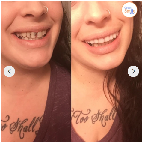 Snap-On Dentures | Buy 1 Get 1 Free!