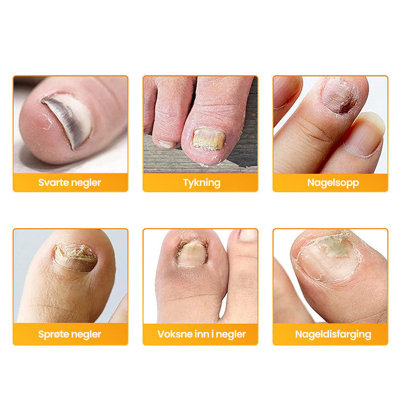 Buy One, Get One Free | Effective Treatment for Nail Fungus