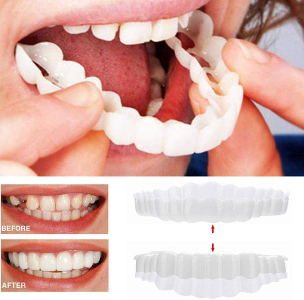 On Smile Veneers for Upper and Lower Jaw