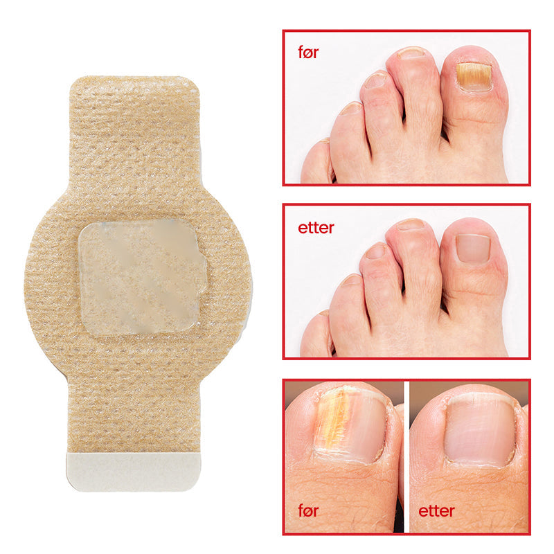 Buy One, Get One Free | Effective Treatment for Nail Fungus
