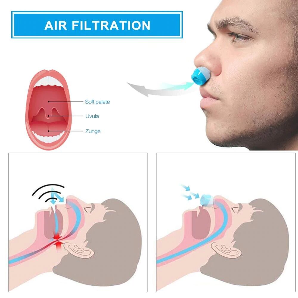 Wireless, Mask-Free Micro-CPAP Anti-Snoring Device