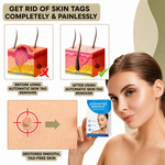 Wart Remover | Pain-Free Removal of Warts & Moles | For Home Use | No Surgery Required