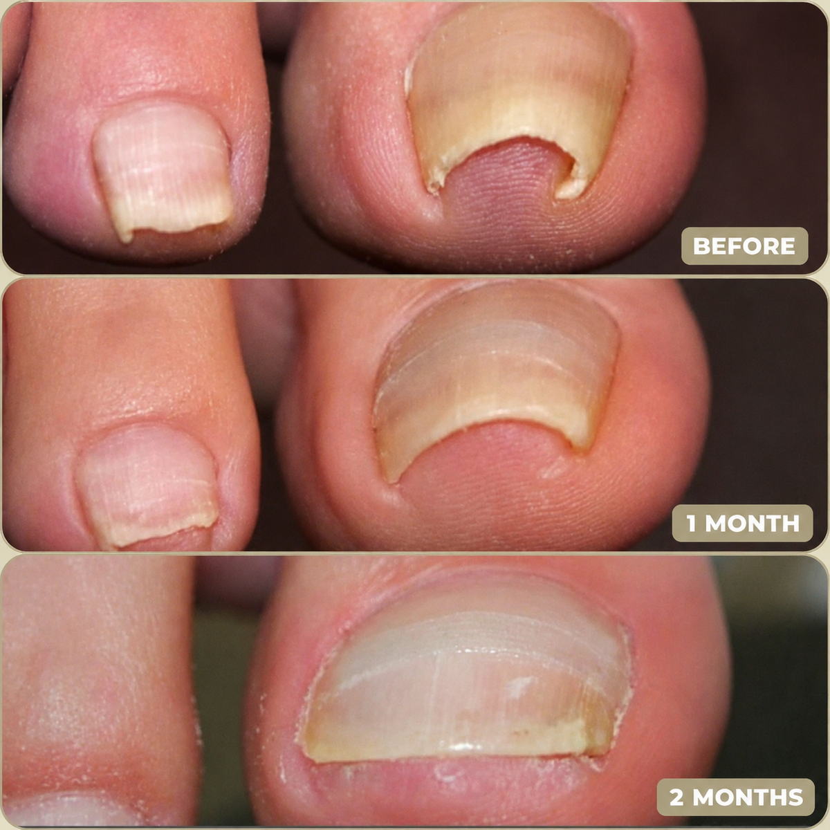 10+10 FREE | Instant Nail Repair Solution