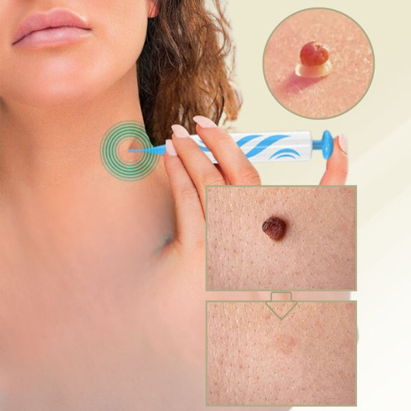 Wart Remover | Pain-Free Removal of Warts & Moles | For Home Use | No Surgery Required