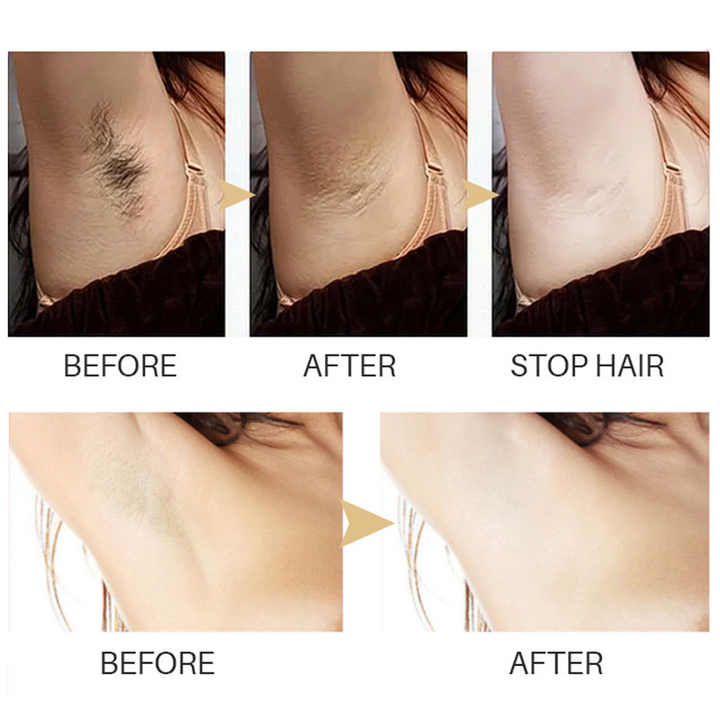 Buy One, Get One Free | Permanent Hair Removal Solution