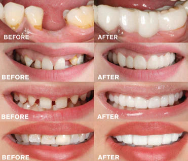 Snap-On Dentures | Buy 1 Get 1 Free!
