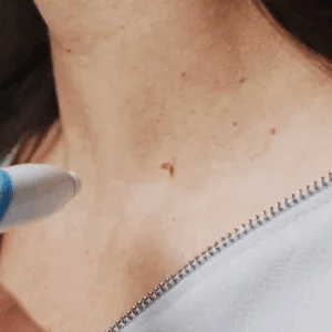 Auto-Tag Removal Kit | Pain-Free Application | Achieve Smooth & Even Skin