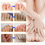 Buy One, Get One Free | Effective Treatment for Nail Fungus